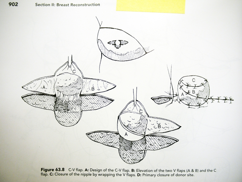 Christoph Zellweger, Instruction Drawing: Nipple Areola Reconstruction