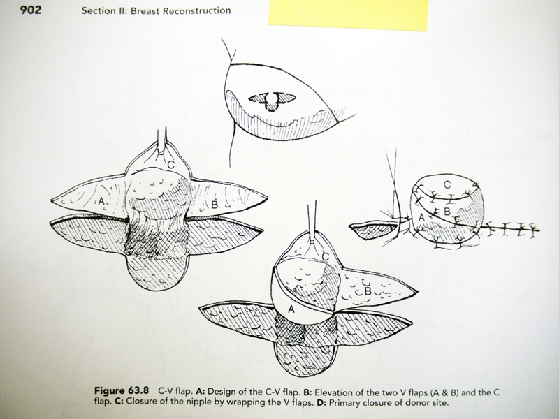 Christoph Zellweger, Instruction Drawing: Nipple Areola Reconstruction, 2012, photo: copyright Christoph Zellweger Christoph Zellweger, Instruction Drawing: Nipple Areola Reconstruction